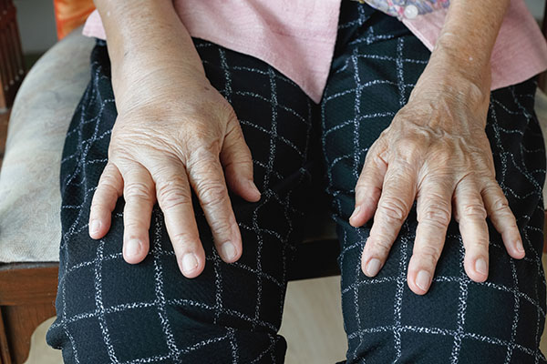 Heart disease related edema